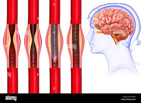 Intracranial Angioplasty Hot Sex Picture