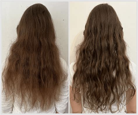 Regrow Hair Clinics Before And After Images