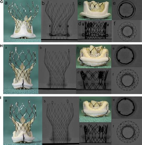 Fluoroscopic Guide To An Ideal Implant Position For Sapien XT And