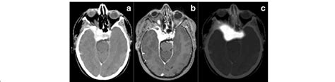 Imaging Of A Typical Skull Base Meningioma On A Contrast Enhanced CT B