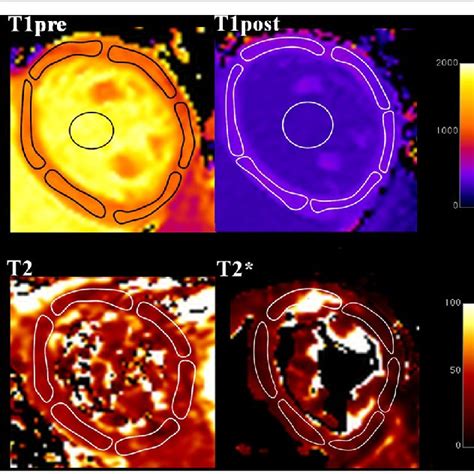 Example Of Native And Post Contrast T1 Mapping T2 And T2 Maps In A