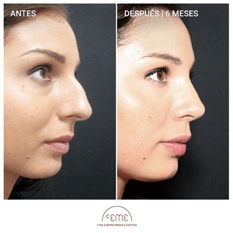 Rinoplastia Ceme