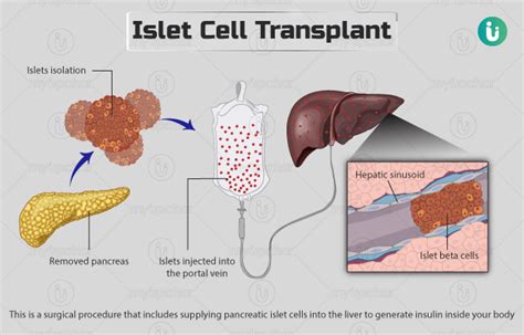 Islet Cell Transplant Procedure Purpose Results Cost Price