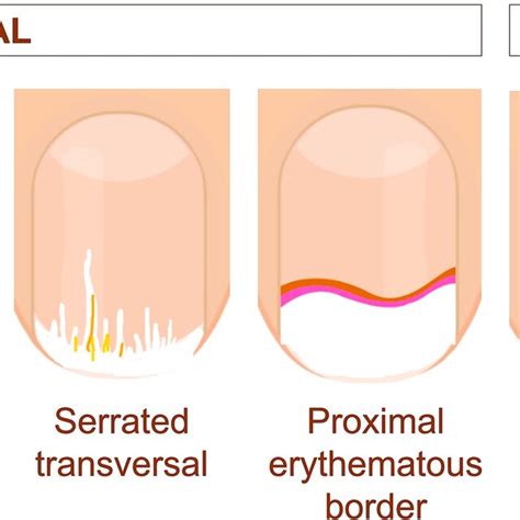 Stages Of Onycholysis A Early Initial Separation B Separation Of