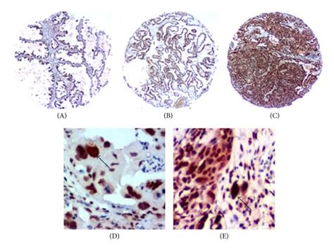 Ezh2 Expression In Human Serous Ovarian Tumor Cells And Caf A Ezh2