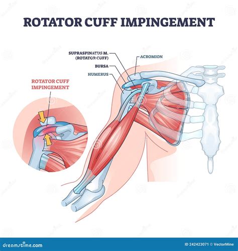 Rotator Cuff Impingement And Anatomical Shoulder Muscle Outline Diagram Coloso