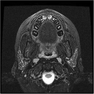 Acute Sialadenitis A Axial Contrast Computed Tomography CT Scan