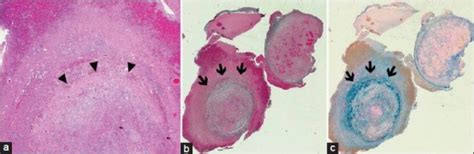 Photomicrographs Of Surgical Specimen Hematoxylin And Eosin Stain Shows