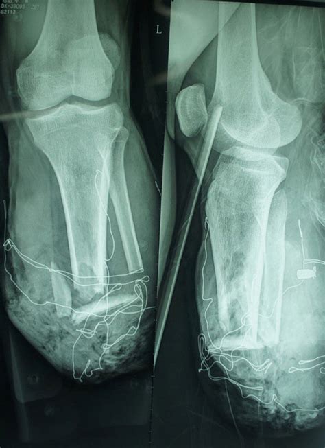 Anteroposterior And Lateral X Ray Images Of The Severed Left Leg