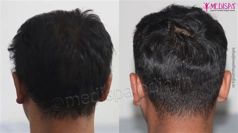 Correction Hair Transplant Results Jaipur Hair Transplant Dubai Cost