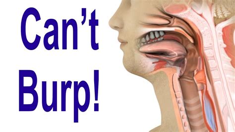 Inability To Burp Retrograde Cricopharyngeus Dysfunction R Cpd Youtube