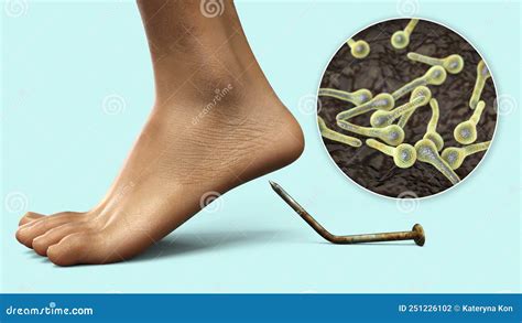 Transmission Of Tetanus Bacteria By Contaminated Wounds D Conceptual