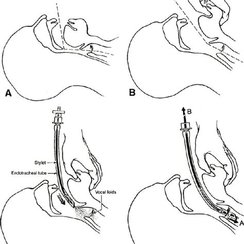 The Shikani Technique For Intubation Using The Shikani Optical Stylet