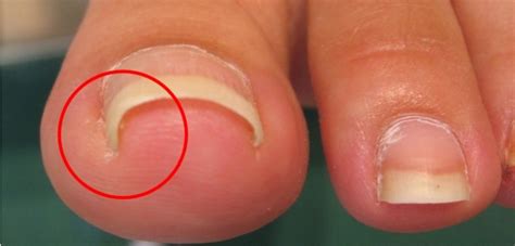 Ingrown Toenail Edmonds Medical Clinic