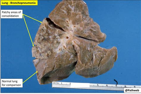 Bronchopneumonia