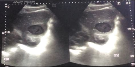 Ultrasound Of The Liver Revealed A Well Defined Hypoechoic Lesion