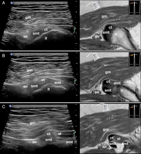 Proximal Hamstring Ultrasound