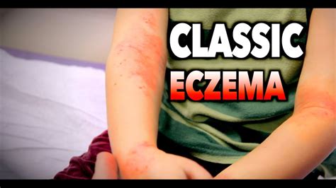 Classic Eczema Atopic Dermatitis Dr Paul Youtube