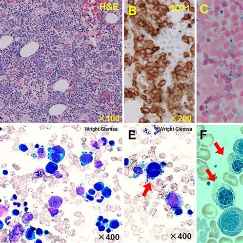 Figure1bone Marrow Findings On Admission A The Clot Section Of The