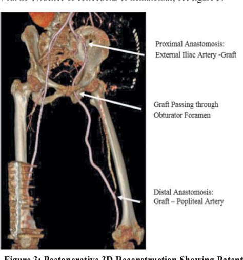 [pdf] Obturator Bypass For Recurrent Infected Femoral Artery Pseudoaneurysm Semantic Scholar