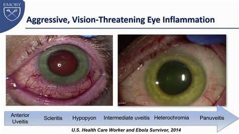 Uveitis Vs Conjunctivitis