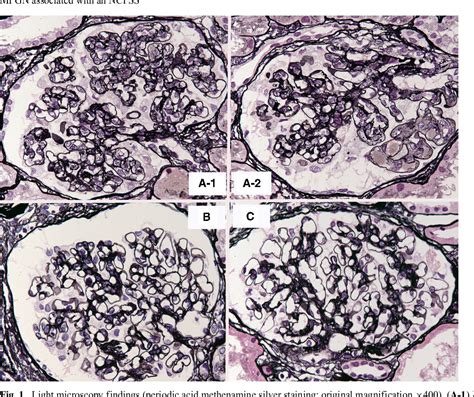 Figure 1 From Remission Of Membranoproliferative Glomerulonephritis Associated With A