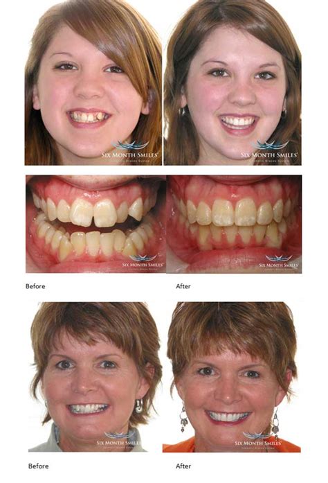 Six Month Smiles Cosmetic Braces System Provided By London Dentist