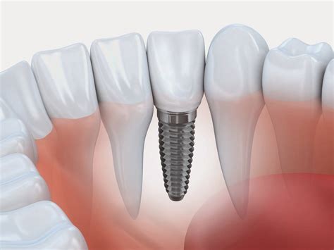 Quanto Custa um Implante Dentário Focalizando