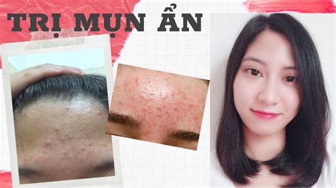 Trị Mụn Ẩn Mụn Đầu Đen Da Sần Sùi Nhanh Hiệu Quả Skincare Routine