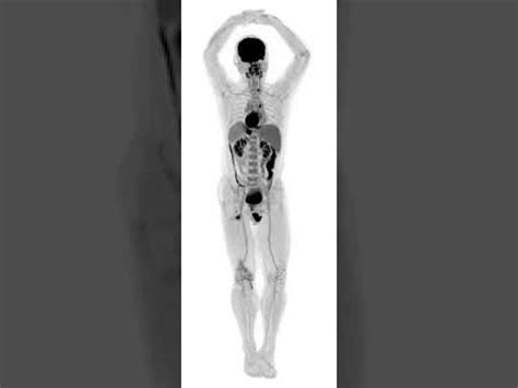 EXPLORER Total Body PET Scan YouTube