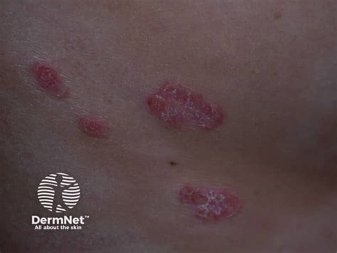 Chronic Plaque Psoriasis Images DermNet