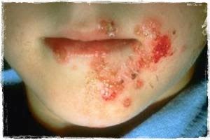 Impetigo Infeccion Bacteriana De La Piel Pediatria Salud Images