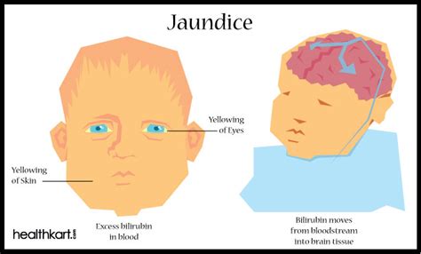 How to deal with Jaundice symptoms? - HealthKart