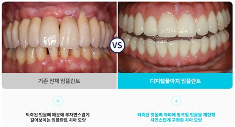 되도록 빨리 예전처럼 식사할 수 있도록 원데이 전체 임플란트 가능할까요 김원장 칼럼