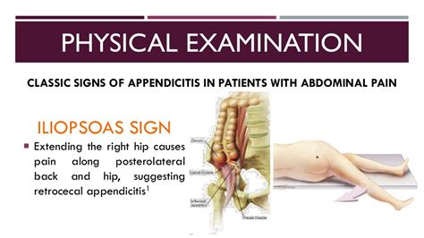 Acute Appendicitis