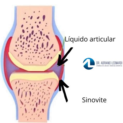 O que é Derrame Articular ou Água no Joelho Especialista do Joelho