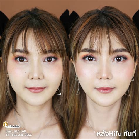 รีวิว HIFU - คลินิกความงาม