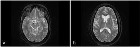 Figure 1 From Neuro Behcets Syndrome Case Report And Literature