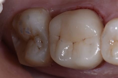 Direct And Indirect Quadrant Dentistry