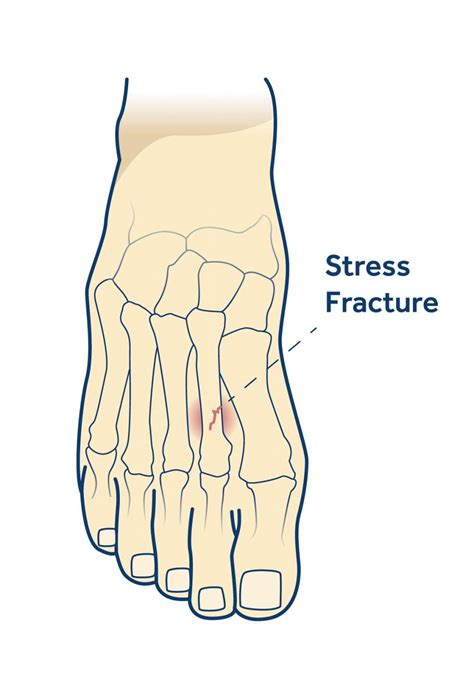 Stress Fractures Dapto Foot Clinic Your Local Podiatrists