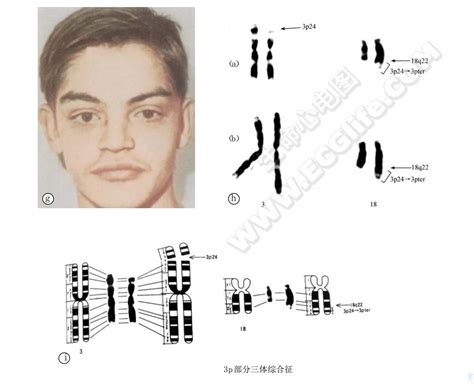 3p部分三体综合征 心血管 天山医学院