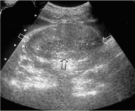 Pelvic Ultrasound Shows A 8 Cm Solid Heterogeneous Pelvic Mass Arrow