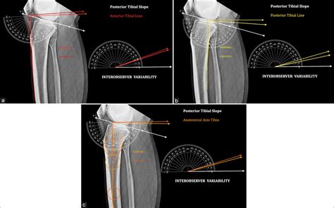 A Novel Precision Technique For Preoperative Planning Of Posterior