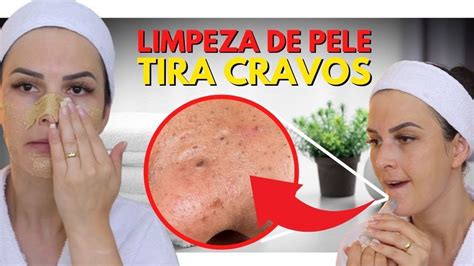 Introduzir Imagem Como Amolecer Cravo Na Orelha Br Thptnganamst