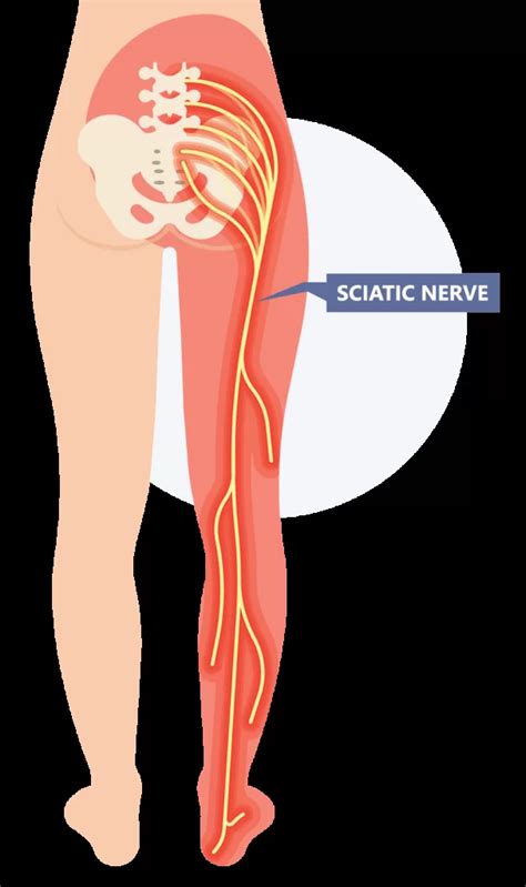 Sciatica Foundation Therapy