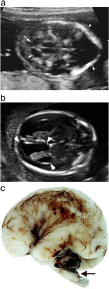 Diagnostic Imaging Of Posterior Fossa Anomalies In The Fetus And