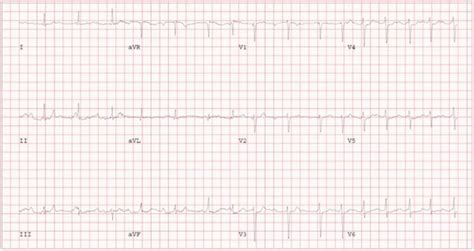 ECG stress test at peak exercise, which demonstrates intermittent ...