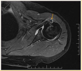 Long Head Biceps Tear-MRI - Sumer's Radiology Blog