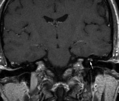 Cranial Nerve Schwannoma Imaging Practice Essentials Computed