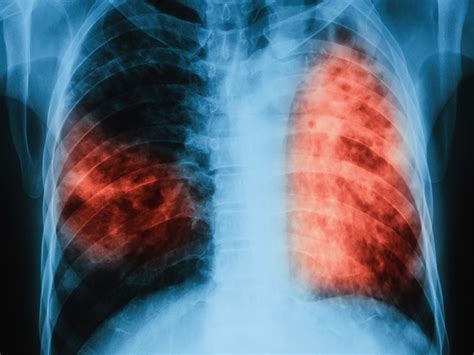 Symptoms Prevention And Other Things To Know About Tuberculosis